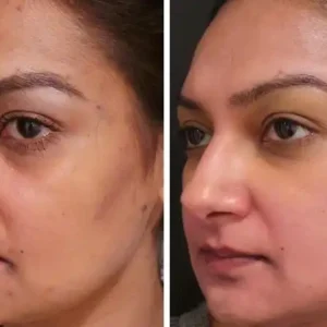 patient1-hydrafacial-san-antonio-tx-before-after-photos